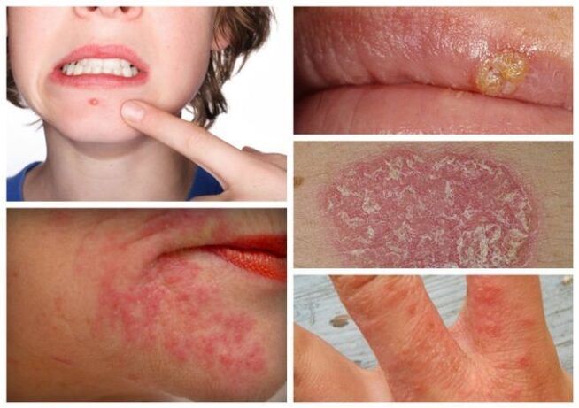 Allergieën en huidziekten zijn tekenen van parasieten in het lichaam