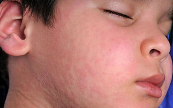 Allergische uitslag op de huid - een symptoom van de aanwezigheid van parasitaire wormen in het lichaam